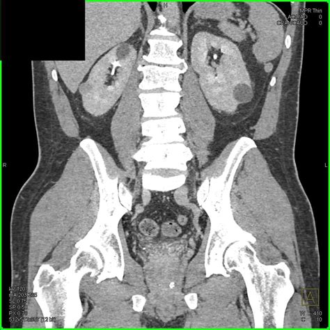High Density Right Renal Cyst On Multiple Phases Kidney Case Studies