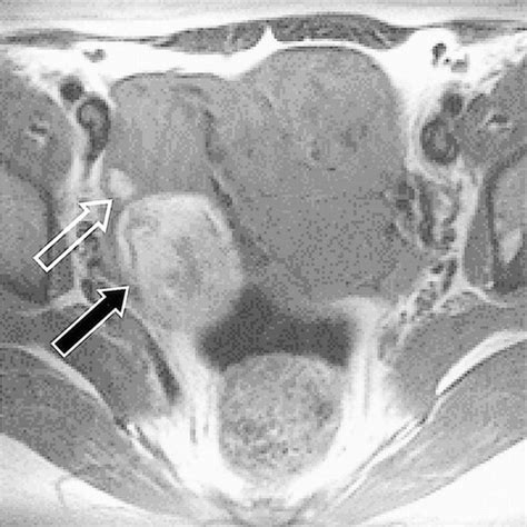 Ovarian Teratomas Tumor Types And Imaging Characteristics Radiographics