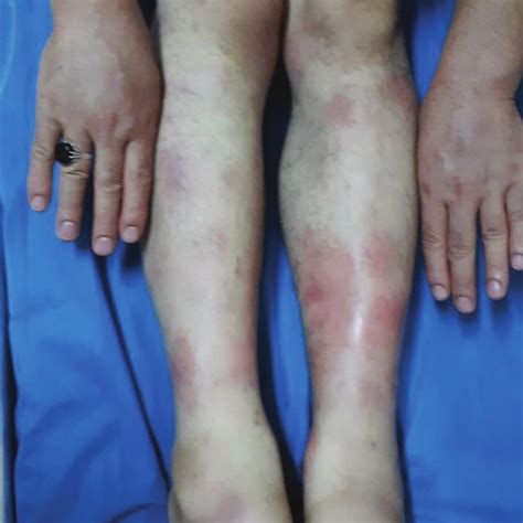 Clinical Image Of Erythema Nodosum On Arms And Legs Download