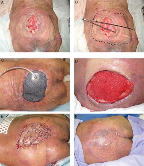 Case Study A Sacral Pressure Ulcer B Wound Presented With