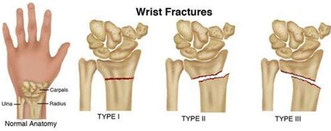 A Wrist Fracture Is A Break In One Of The Bones Near The Wrist Most
