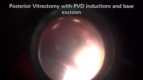 Vitrectomy For Retinal Detachment Youtube
