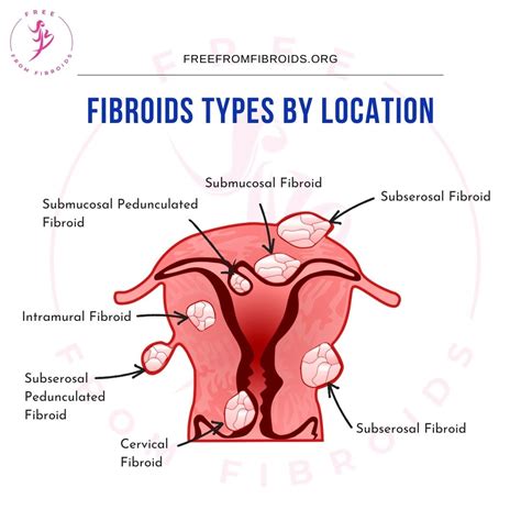 Uterine Fibroid Symptoms List Free From Fibroids Foundation