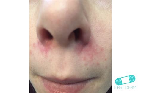 Online Dermatology - Cradle Cap (Seborrheic dermatitis)