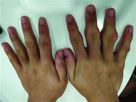 Photograph Of Both Hands Shows Saccular Soft Tissue Swelling Of The