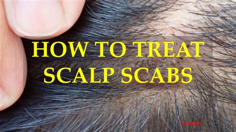 How To Treat Scalp Scabs Youtube