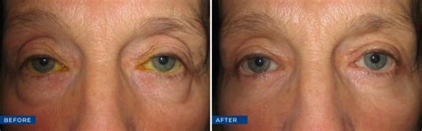 Oculoplastic Surgery Before And After Gallery Eye Care Associates Of