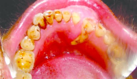 A Large Swelling On The Left Mandibular Anterior Region With