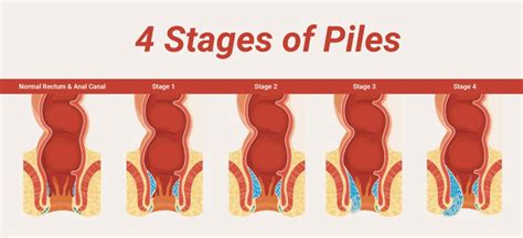 Colon Cancer Vs Piles The Confusion Between Piles And Colon Cancer Dr Maran On Similar