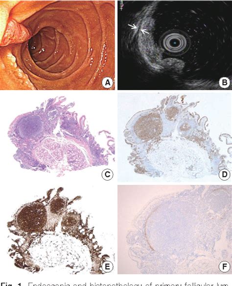 Figure 1 From Primary Follicular Lymphoma Of The Duodenum A Case