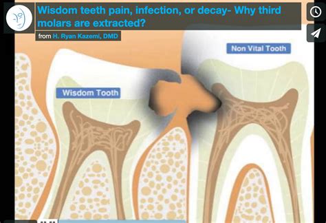 Wisdom Teeth Pain Infection Or Decay Why Third Molars Are Extracted
