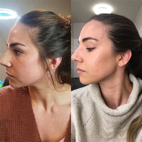 I had bilateral tmj arthroplasties done, which were unsuccessful. Getting Botox Therapy for TMJ and Jaw Pain Relief