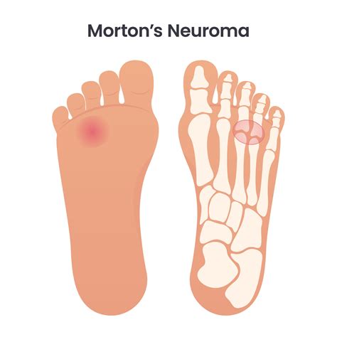 Mortons Neuroma Silver Chiropractic And Wellness