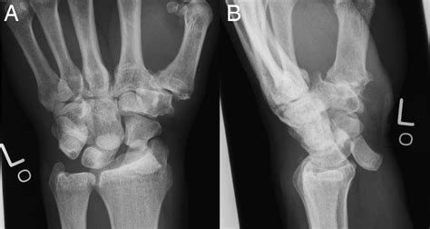 Isolated Scaphoid Fracture With Palmar Dislocation Of The Proximal