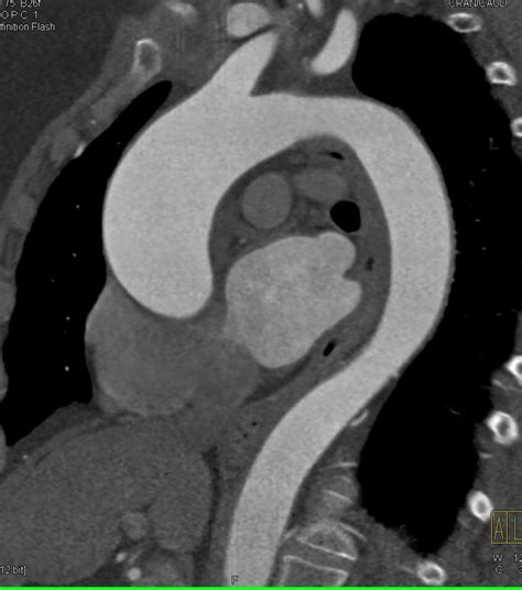 Dilated Ascending Aorta Chest Case Studies Ctisus Ct Scanning