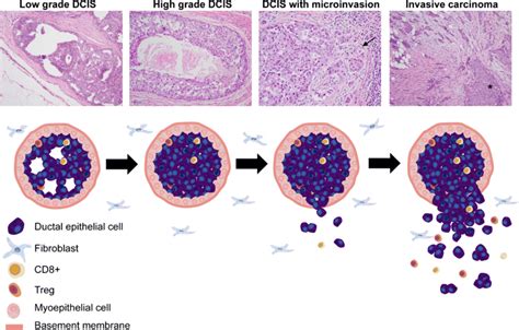 Invasive Ductal Carcinoma Stages