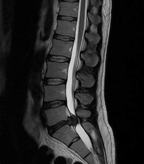 Cauda Equina Syndrome Spine Orthobullets