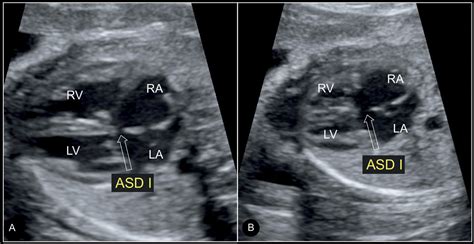 Significant dilatation of the coronary sinus is usually the result of some form of anomalous drainage. Atrial, Ventricular, and Atrioventricular Septal Defects ...