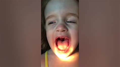 Giant Toddler Tonsils Youtube