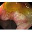 Large Duodenal Ulcer Photograph By Gastrolab