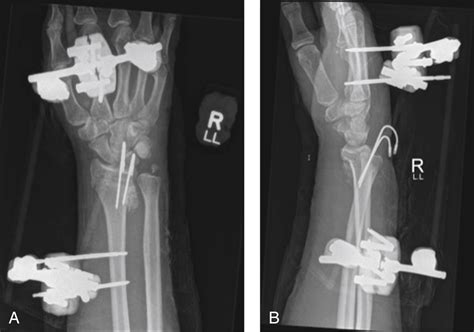 External Fixation Of Distal Radius Fractures Musculoskeletal Key