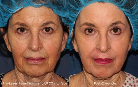 Actual Un Retouched Patient Before And After Co2 Laser Treatment For