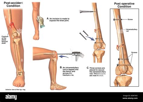 Distal Femur Fractures With Retrograde Surgical Fixation With Stock