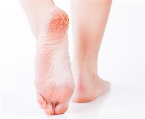 Dry Skin On Feet Causes Symptoms Home Remedies And Treatment Pictures