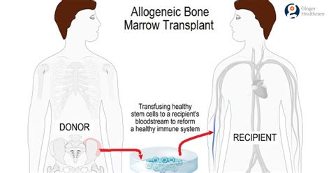 Bone Marrow Transplant What It Is When And How It Is Done