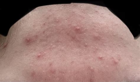 Blind Pimples And Nodular Acne Getting Worse And Multiplying In