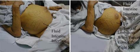 Ascites With Shifting Dullness Ascitic Fluid Will Grepmed