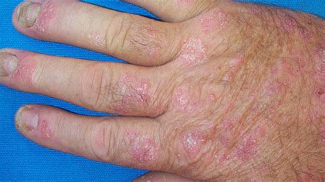 Types Of Psoriasis Pictures Symptoms And Treatments