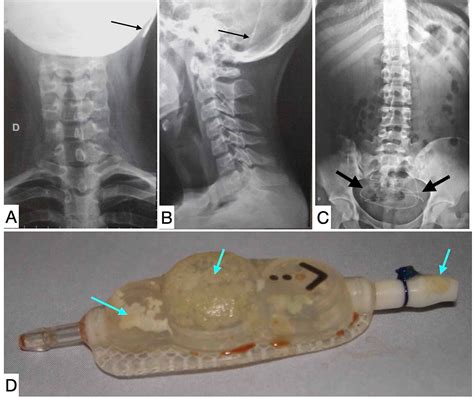 Cureus Abdominal Complications Related To Ventriculoperitoneal Shunt Placement A