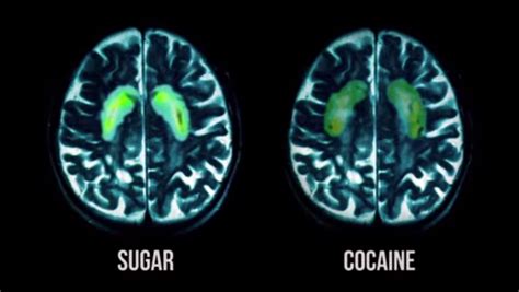 What Happens To Your Brain On Sugar Explained By Science