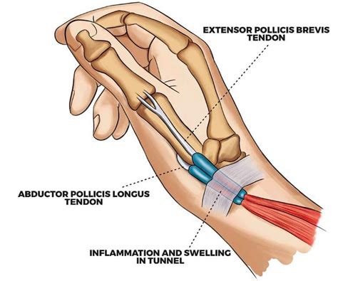 De Quervains Tenosynovitis Aka Texting Thumb