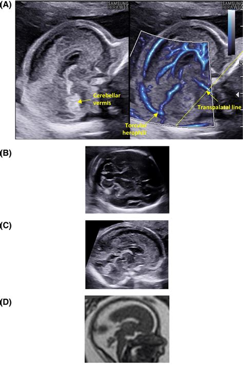Ac Neurosonogram In A Fetus With Dandywalker Malformation Imaged At