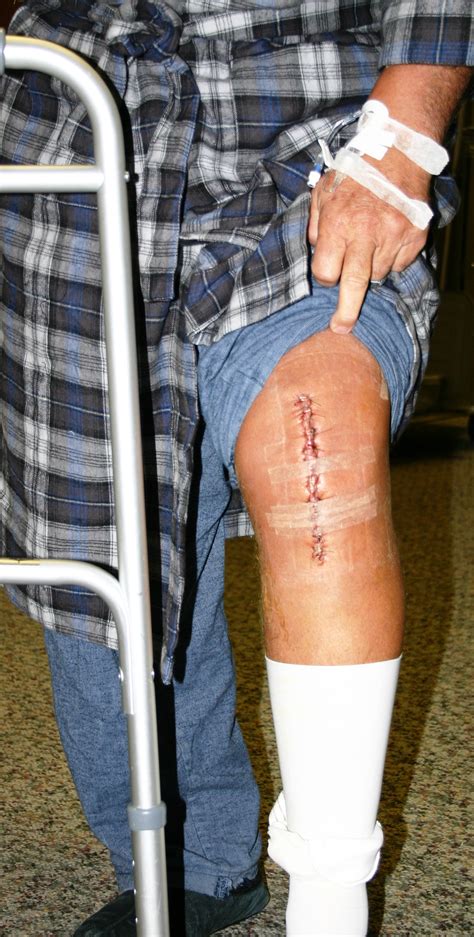 I really need this knee bent before the 20th. TKR scar (2) - Dr. Stuart Kozinn, MD - TotalKnee.Org Dr ...