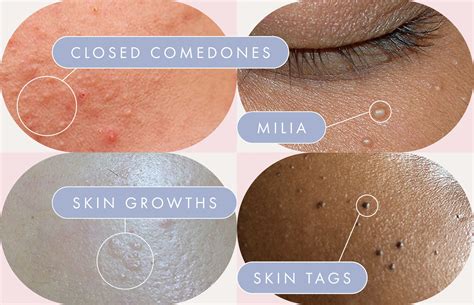 Little Bumps On Skin Offers Sale Save 70 Jlcatjgobmx