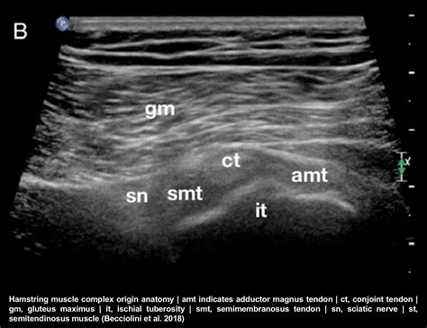 Hamstring Injuries As An Indication For Ultrasound Imaging