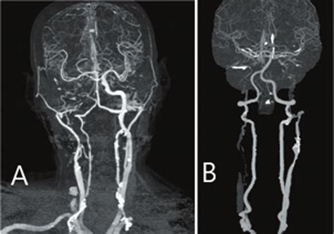 Ct Angiography Cta Demonstrates Severe Carotid Artery Occlusion