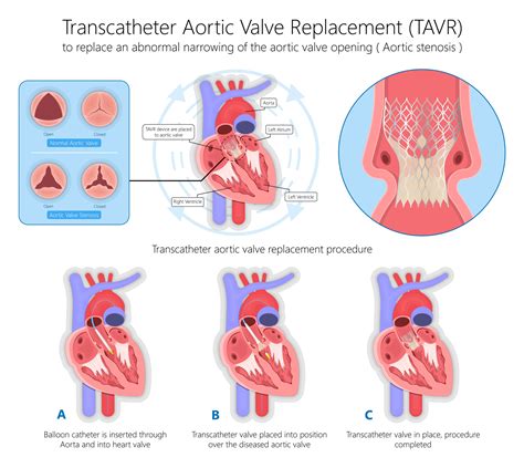 Transcatheter Aortic Valve Replacement Tavr Procedure Salinas Ca