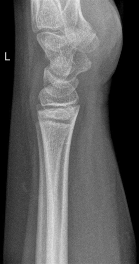 Normal Lateral Wrist Radiograph Pediatric Image