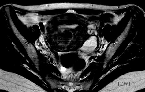 My E Radiology Cases Case 149 45 Year Old Woman With Lt Ovarian Cyst