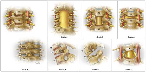 Cervical Osteotomy Types Neupsy Key