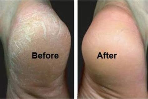 How To Treat Cracked Feet Diy Tag
