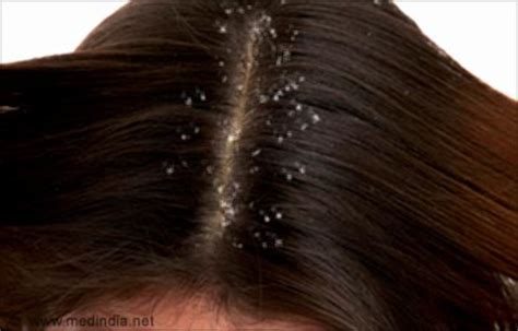 What Is Dandruff? How to Treat Dandruff? | HubPages