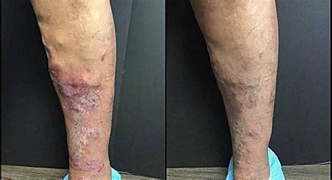 Before And After Dallas Tx And Hurst Tx Dallas Vein Institute