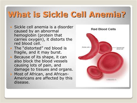 PPT Sickle Cell Anemia PowerPoint Presentation Free Download ID