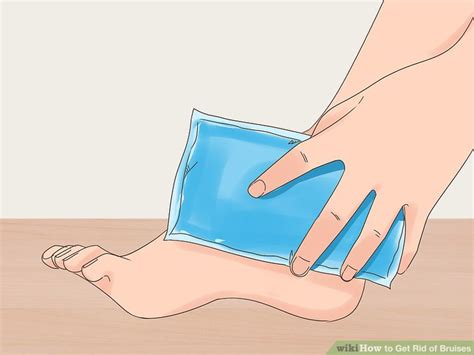 How To Get Rid Of Bruises How To Do Anything