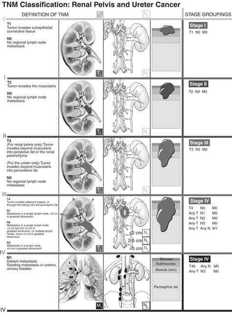 Illustrated Tnm Staging Of Renal Pelvis And Ureteric Tumors